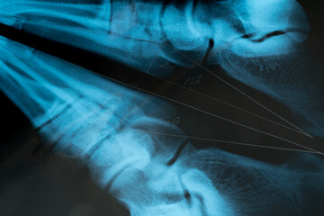 Close up view of X-ray print showing combined image of human platypodia example. Flat feet postural deformity.