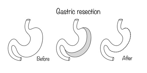 Gastric resection