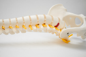 Lumbar spine displaced herniated disc fragment, spinal nerve and bone. Model for treatment medical...