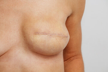Post-mastectomy breast with reconstruction and surgical scars