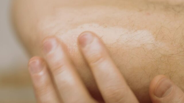 Vitiligo Unveiled: Intimate Study of Male Elbow. Skin's Chromatic Symphony. Dermatological Diversity Close-Up. Visualizing Autoimmune Skin Patterns