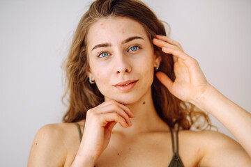 Beautiful young girl with problem skin. Young woman with wavy hair gently touching her face....