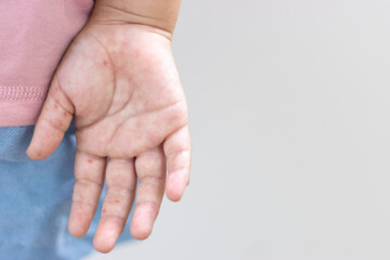 手足口病になった女の子の手のひら（4歳、日本人）