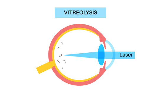 Vitreolysis laser treatment