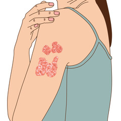 Woman's brachium psoriasis itching from infection fungus or tinea versicolor, illustration on white background