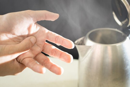 Close up of hands,woman dropped a kettle of boiling water and scalded her hand,burning pain,physical injury,scald the skin with boiling liquid,hot steam in electric kettle,hot water danger,accident.