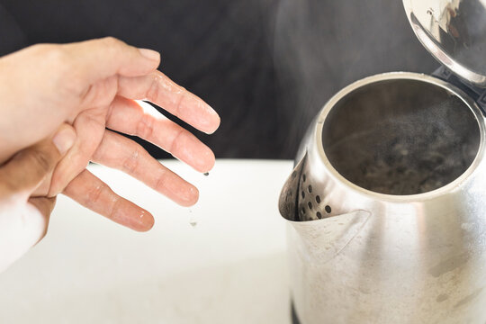 Woman&rsquo;s hands with burning pain from scalding heat water,boiling water and hot steam in the electric kettle spilled onto skin of her hand,girl suffering harm and injury,scald blister,accident at home