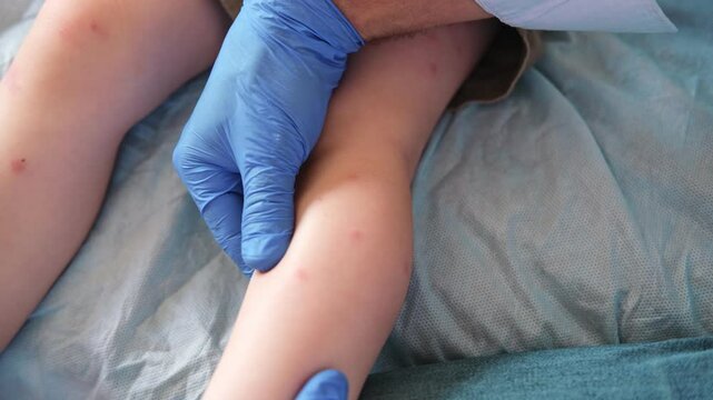 Doctor examining child with bodily red rash. Kid allergy closeup. Little baby scratches an eruption. Nurse applies special cream to atopic skin. Dermatitis, irritation, hive. Pruritus. Mosquito bites