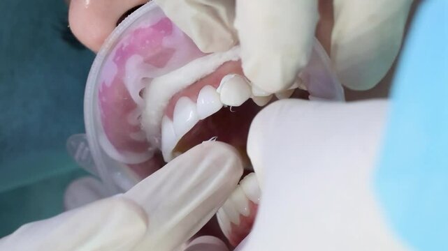 close up fitting of ceramic veneers on the teeth of the upper jaw