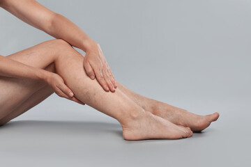 Woman suffering from varicose veins on grey background, closeup