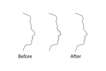 Rhinoplasty nose plastic surgey icon. Vector rhinoplasty beauty icon.