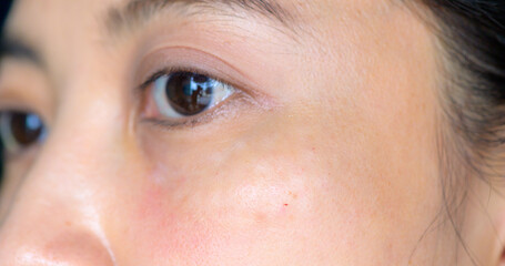 Obraz premium Swelling from needle after cosmetic procedures, reducing wrinkles under eyes. Beauty medical procedure.