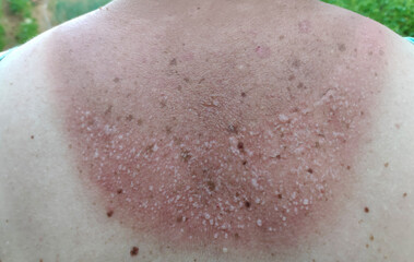 Naklejka premium Closeup of sunburned back showing a tan line from a shirt, highlighting skin damage from sun exposure.