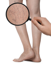 Woman suffering from varicose veins on white background, closeup. Affected leg, zoomed view through...