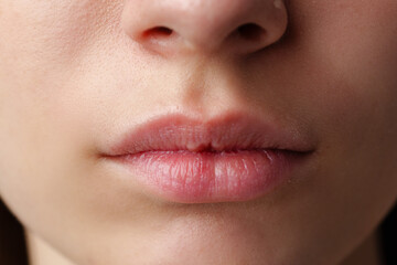 Close Up of a Woman's Lips With Dry Skin