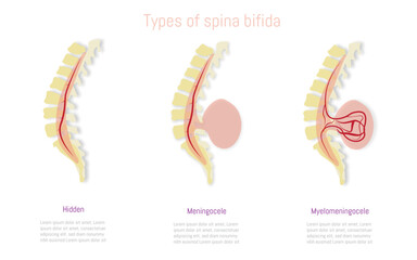 Medical illustration depicting types of spina bifida: hidden, meningocele, and myelomeningocele with detailed spinal anatomy.