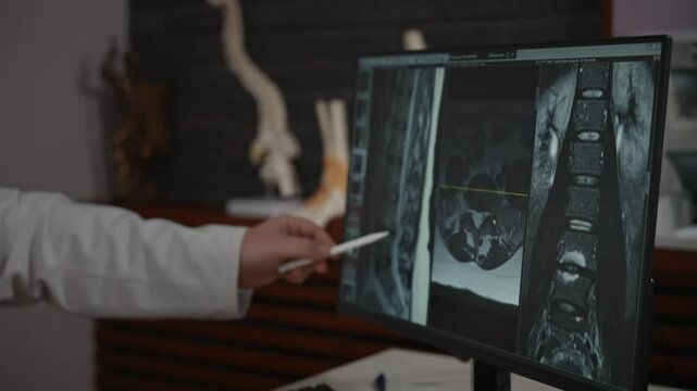 An unrecognizable doctor examines an MRI image on a computer screen. The accuracy of the diagnosis depends on the qualifications of the doctor and the accuracy of the x-ray.