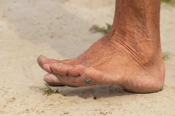 A black thorn from a plant in the foot.A man pulls a splinter from his foot on the beach.