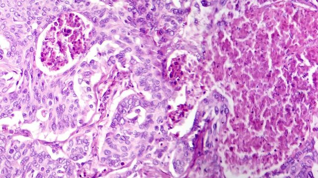 Light microscopy of lung adenocarcinoma, a malignant tumor originating from glandular cells in the lung. Histologically, it shows atypical glandular structures, and increased mitotic activity.
