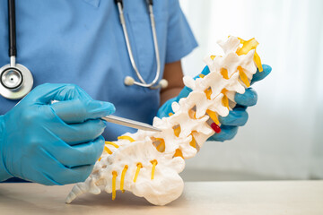 Doctor holding lumbar vertebrae spine skeleton bone and spinal nerve with displaced herniated disc fragment for treatment medical in the orthopedic department.