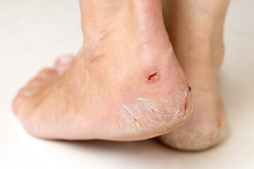 Female feet with cracked heels close up