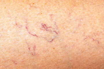 Vascular network of capillaries on the female leg close up background