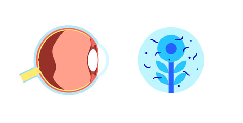 Myodesopsia eye floaters