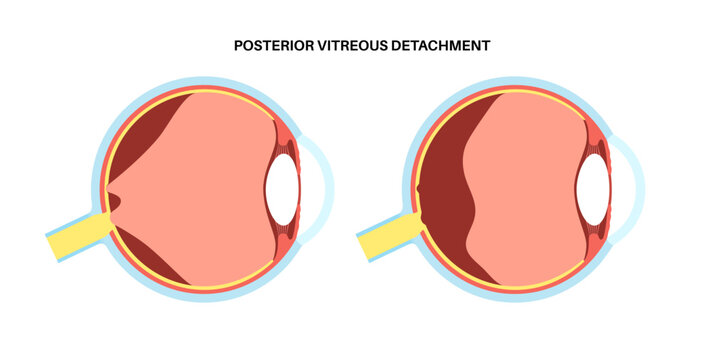Posterior vitreous detachment
