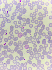 A smear of human blood under a microscope. Blood cells, red blood cells, white blood cells.