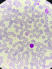 A smear of human blood under a microscope. Blood cells, red blood cells, white blood cells.