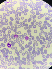 A smear of human blood under a microscope. Blood cells, red blood cells, white blood cells.