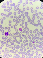 A smear of human blood under a microscope. Blood cells, red blood cells, white blood cells.