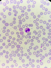 A smear of human blood under a microscope. Blood cells, red blood cells, white blood cells.