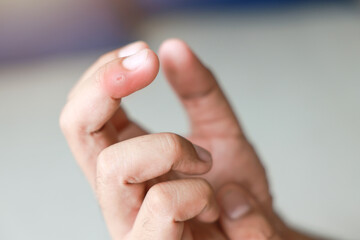 Young man injured his finger and it was swollen and red. Cause of pain include Infected wound. male...