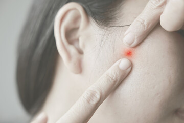 Asian Young woman has inflamed and red acne on her cheeks. Acne breakouts cause inflammation. concept of Health care, medical, Beauty.