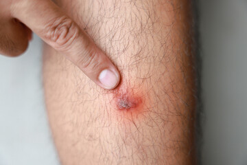 Fototapeta premium A man verruca vulgaris his leg. Causes of Symptoms of Human Papilloma Virus infection in wounds causes bumps and rough skin. Healthcare medical concept.