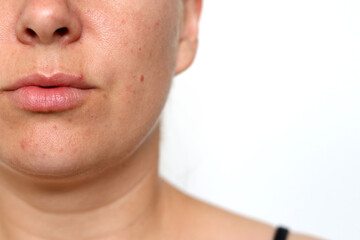 Close up of female face with red problematic acne skin and scars