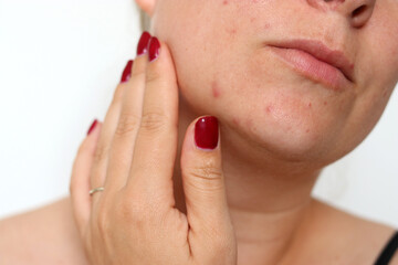 Naklejka premium Close up of female face with red problematic acne skin and scars