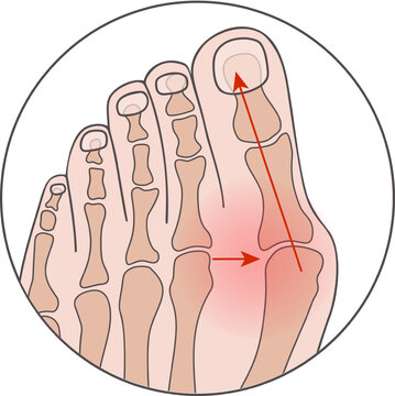 Medical vector illustration of Hallux valgus. Circled footnote
