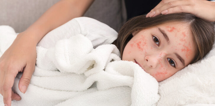 Girl With Measles Virus Lying On Mother Knees, Mom Stroking Her Daughter
