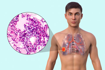 Naklejka premium A man with lung cancer, 3D illustration and micrograph