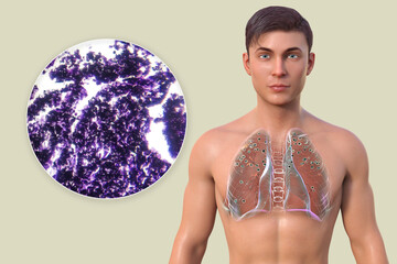 Naklejka premium 3D illustration and light micrograph depicting a man with lungs affected by silicosis