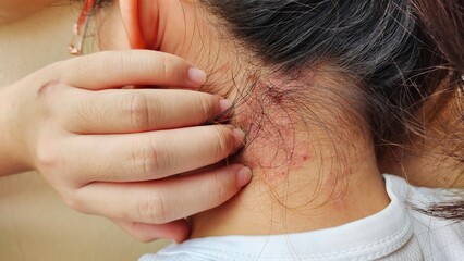 portrait the rash, hives, allergy and inflammation skin, reaction and urticaria, scar and acne,...