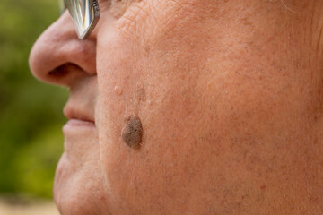 Close-Up of Brown Seborrheic Keratosis (Seborrhoeic wart, Basal cell papilloma, Senile wart) Skin...