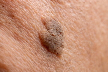 Close-Up of Brown Seborrheic Keratosis (Seborrhoeic wart, Basal cell papilloma, Senile wart) Skin...