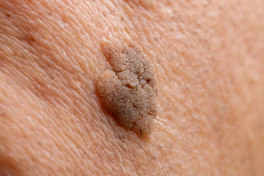 Close-Up of Brown Seborrheic Keratosis (Seborrhoeic wart, Basal cell papilloma, Senile wart) Skin Growth on Cheek