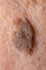 Close-Up of Brown Seborrheic Keratosis (Seborrhoeic wart, Basal cell papilloma, Senile wart) Skin Growth on Cheek
