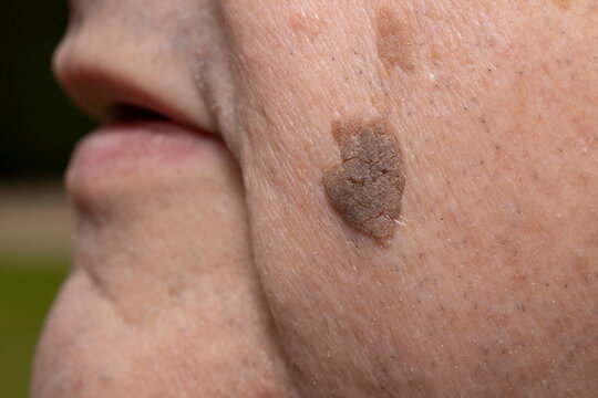 Close-Up of Brown Seborrheic Keratosis (Seborrhoeic wart, Basal cell papilloma, Senile wart) Skin Growth on Cheek