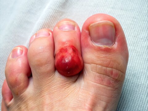 A close-up of a painful amel toe, also known as turf toe, showcasing a red, swollen, and bruised