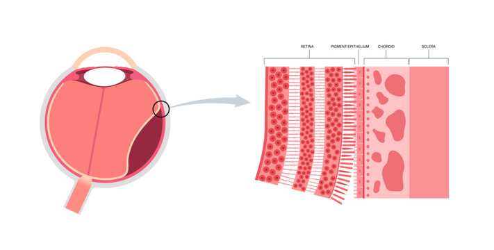 Retinal detachment eye disease